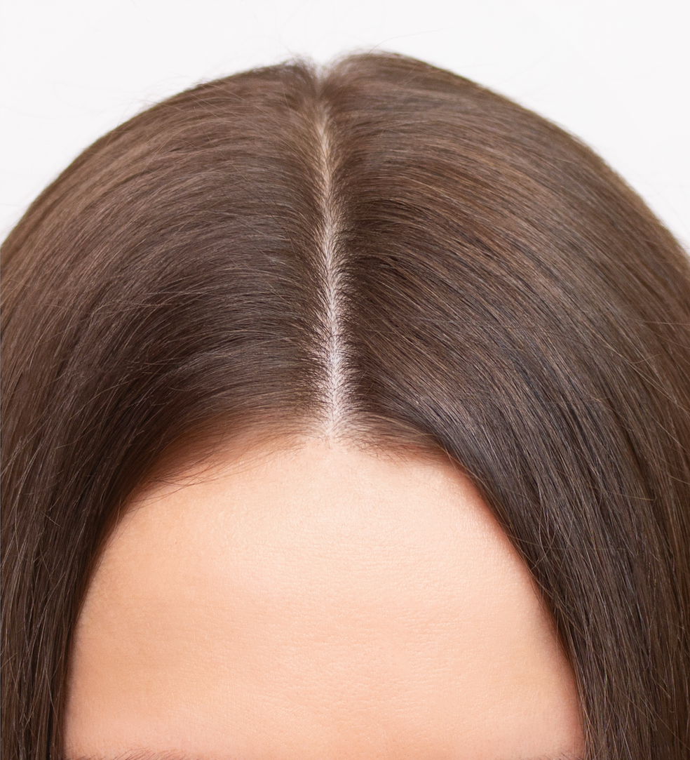 chute de cheveux femme perte de cheveux hormonale femme alopécie féminine diminution volume cheveux femme solution perte de cheveux femme
